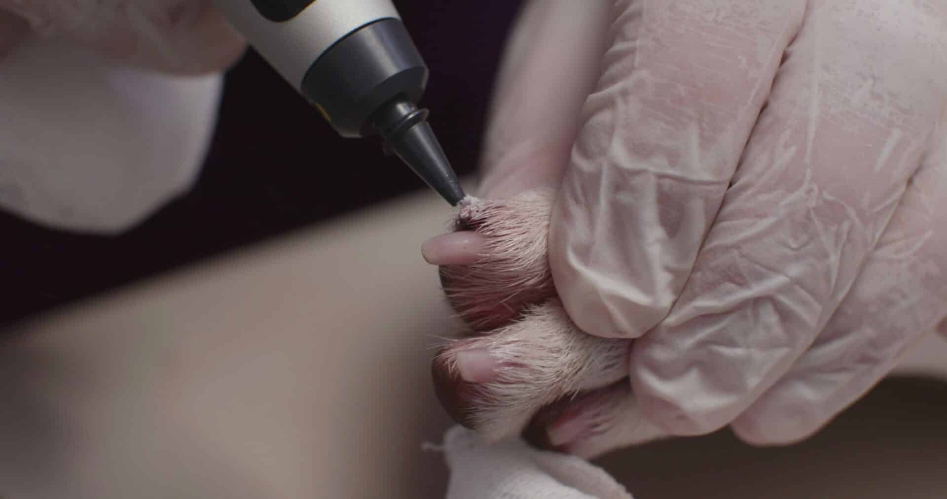 Cryotherapy for Select Skin Lesions and Growths